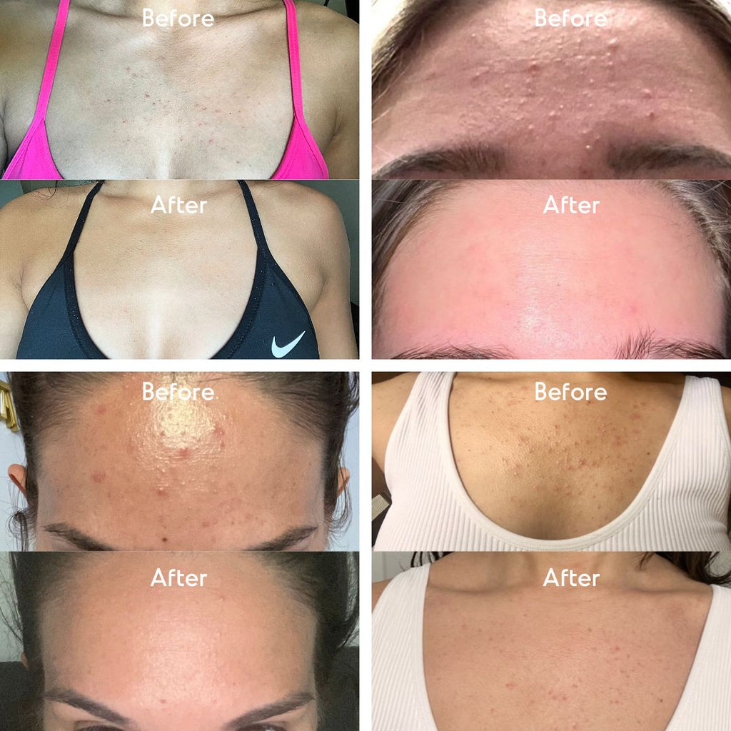 Fungal Acne: Effective Solutions for Clear Skin