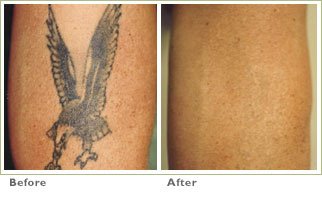 Q Switch Laser Tattoo Removal